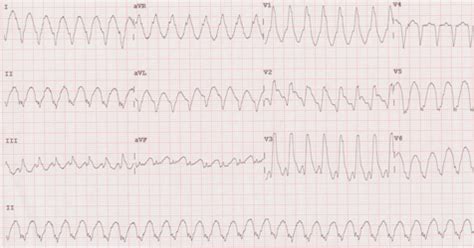 Ventricular Arrhythmias