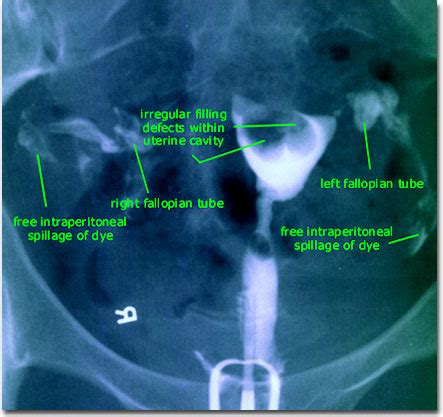 Dr. Eric Daiter, MD - Causes of Miscarriages and Available Treatments ...