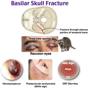 Basilar skull fracture,WHAT TO KNOW?