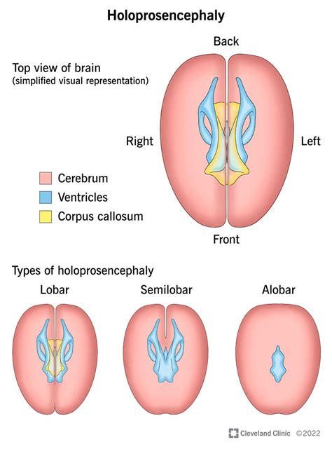 Holoprosencephaly (HPE): What It Is, Causes & Types