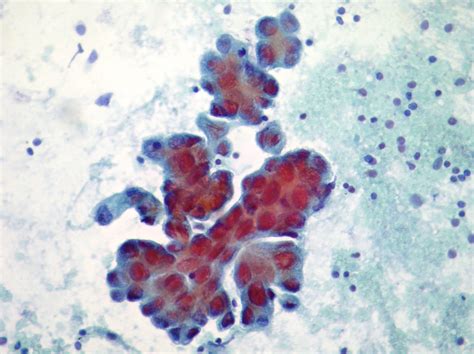 Cytopathology of lymph nodes-FNAC – Cellnetpathology.com