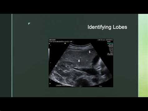 Ultrasound and Liver Segments - YouTube