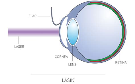 LASIK laser eye surgery in London | David Gartry eye surgery