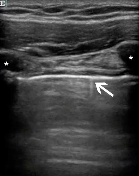 Clinician-performed Beside Ultrasound for the Diagnosis of Traumatic ...