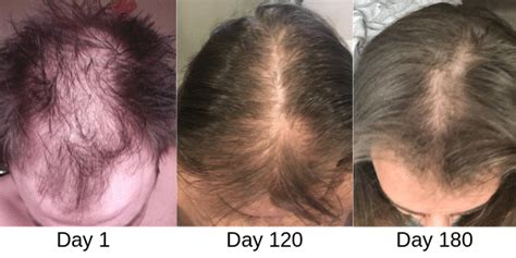 What is a Laser Hair Growth Cap? - Everything You Need to Know