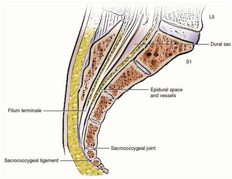 Ultrasound-Guided Injection Technique for Coccydynia | Anesthesia Key