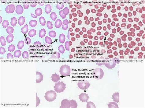 Haematology in a NutShell: Crenated RBCs (Echinocytes)