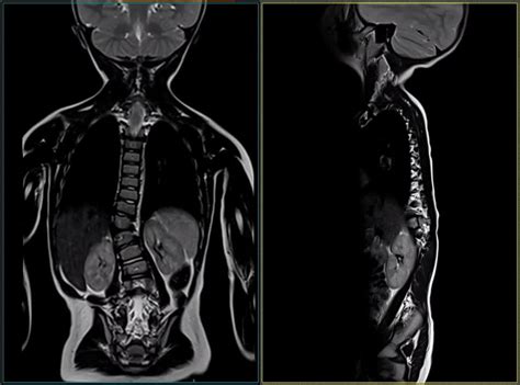 Predrag Pavlovic on LinkedIn: MRI Spine Patient two years old with ...