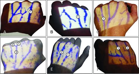 (A) Left hand showing prominent dorsal metacarpal vein (1) in the... | Download Scientific Diagram