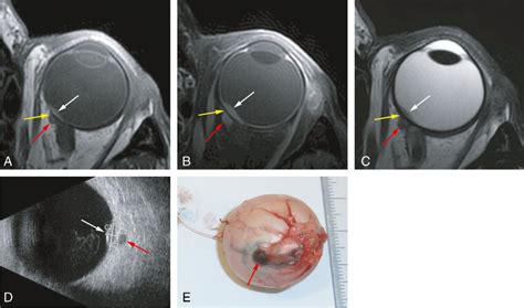 MR and grossing images of a uveal melanoma with extrascleral extension ...