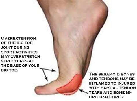 [DIAGRAM] Diagram Of Big Toe Pain - MYDIAGRAM.ONLINE