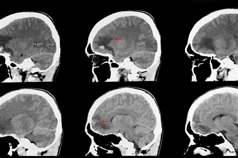 Cerebral (Brain) Contusions