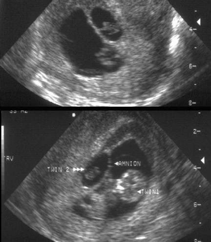 Vanishing Twin Syndrome Ultrasound