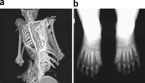 Characteristic clinical features of fibrodysplasia ossificans... | Download Scientific Diagram