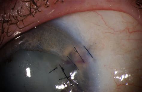 Moran CORE | Removal of Superficial Corneal Foreign Bodies