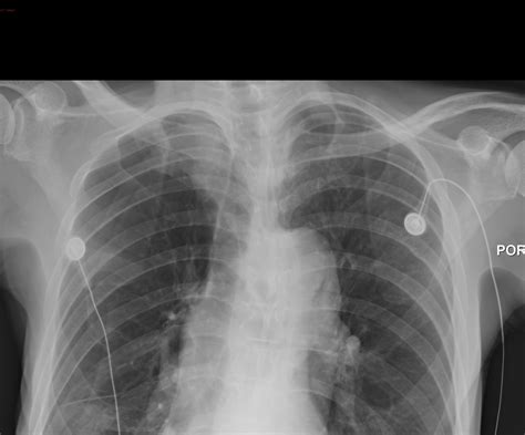 Boring Question: How does the sensitivity/specificity of lung ultrasound compare to plain films ...