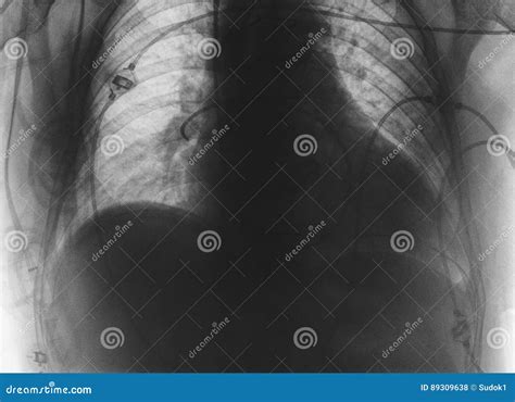 Medical Roentgen Image of Patient Stock Photo - Image of chest ...