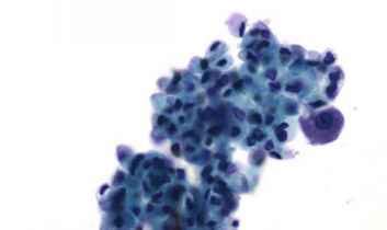 Atypical Urothelial Cells Indeterminate for Neoplasia - Urothelial Cells