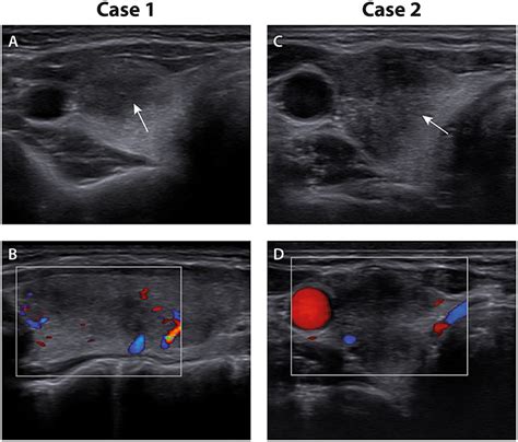 Subacute Thyroiditis Ultrasound