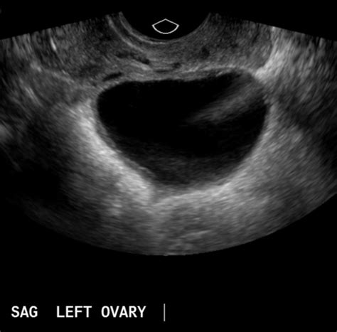 Ovarian Follicle Ultrasound