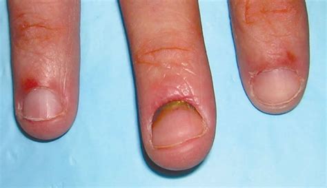 Hangnail & infected hangnail causes, symptoms, diagnosis & treatment