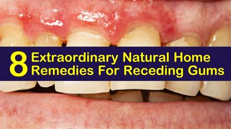 8 Extraordinary Natural Home Remedies For Receding Gums