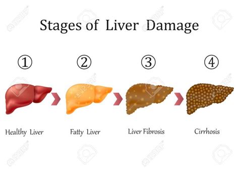 Fatty Liver and Lipotropic factors – Biochemistry Basics by Dr. Amit ...