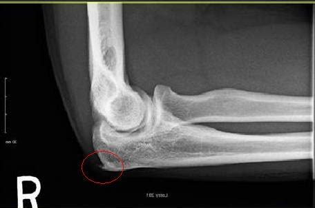 Bone Spur Elbow