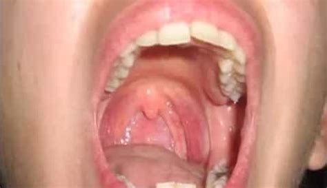 Itchy Roof of Mouth: Causes and Treatment - UTODENT