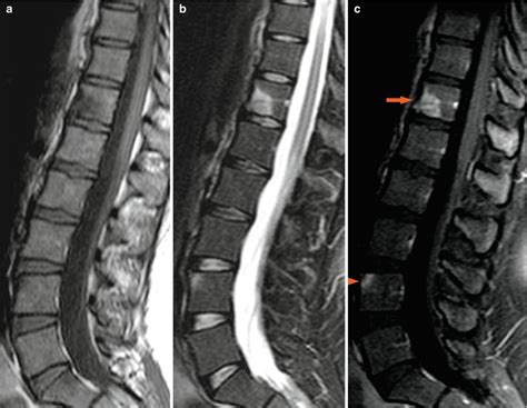 Psoriatic Arthritis | Radiology Key