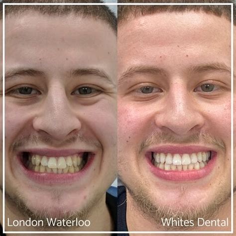 How Much Does Composite Bonding Cost in the UK? | Whites