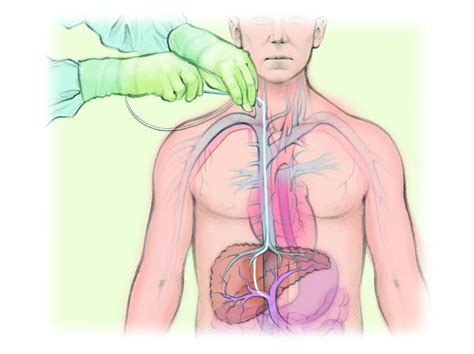 Transjugular intrahepatic portosystemic shunt (TIPS) — The ...