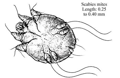Scabies | Flickr - Photo Sharing!