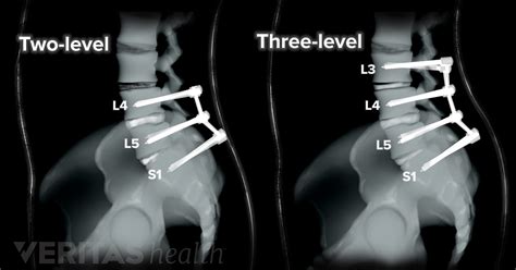 Spinal Fusion Surgery L5 S1