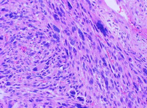 Malignant Fibrous Histiocytoma (MFH): Undifferentiated Pleomorphic ...