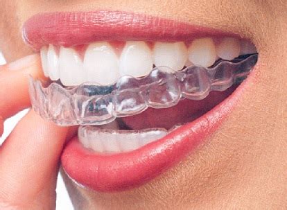 Pros and Cons of Clear Aligners – SDalign Invisible Braces – Clear ...