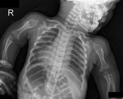 Achondroplasia - wikidoc