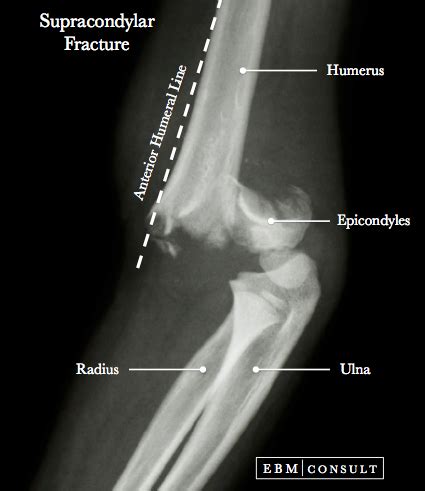 Supracondylar Fracture - General Review