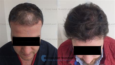 Civas Hair Transplant- FUE Hair Transplant Before & After Pictures (3700 Grafts) | Hair loss ...