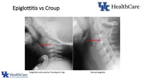 Epiglottitis Thumbprint Sign