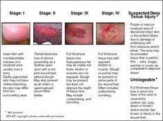 Figure B depicts the NPUAP pressure ulcer stages I - IV with descriptions of the stages and an ...