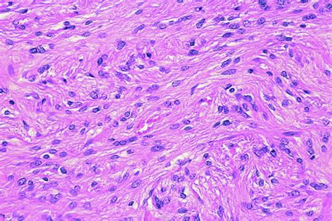 Neoplasm: Spindle Cell Neoplasm Lung