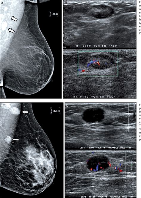 Figure 1 from Abnormal axillary lymph nodes on negative mammograms ...