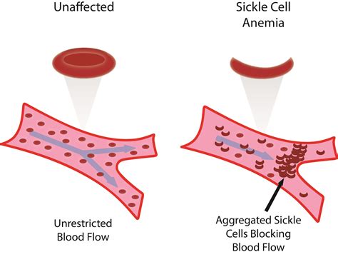 Sickle Cell Disease/Sickle Cell Anemia - Stepwards