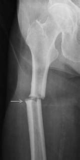 Complications Of Fracture - Early and Late Complications Of Fracture