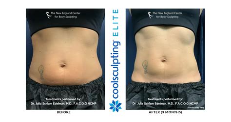 Laser Lipo vs. CoolSculpting Elite: Which Is Best for You?