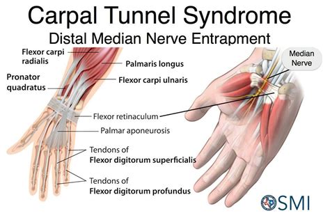 Carpal Tunnel syndrome: Avoid Surgery - PhysioPrescription