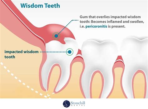 Impacted Wisdom Teeth | Stonehill Dental: Hamilton Dentist