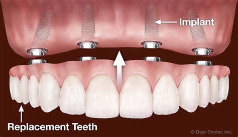 Cosmetic Dentistry Manahawkin, NJ | Implant Dentistry