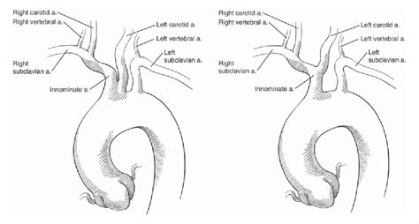 Figure 1 from 'Bovine' aortic arch - a marker for thoracic aortic disease. - Semantic Scholar